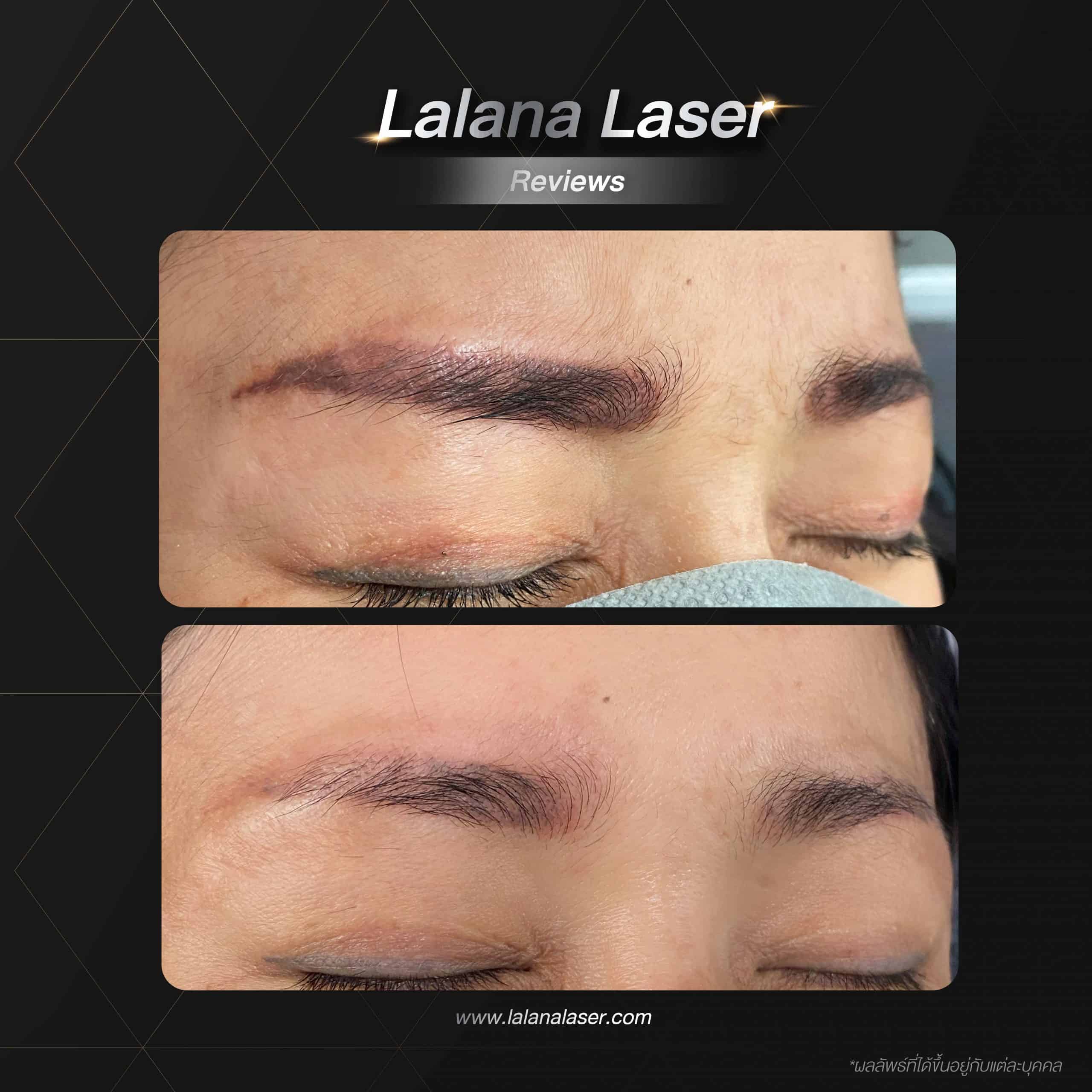 Lalana-laser-reviews-scaled
