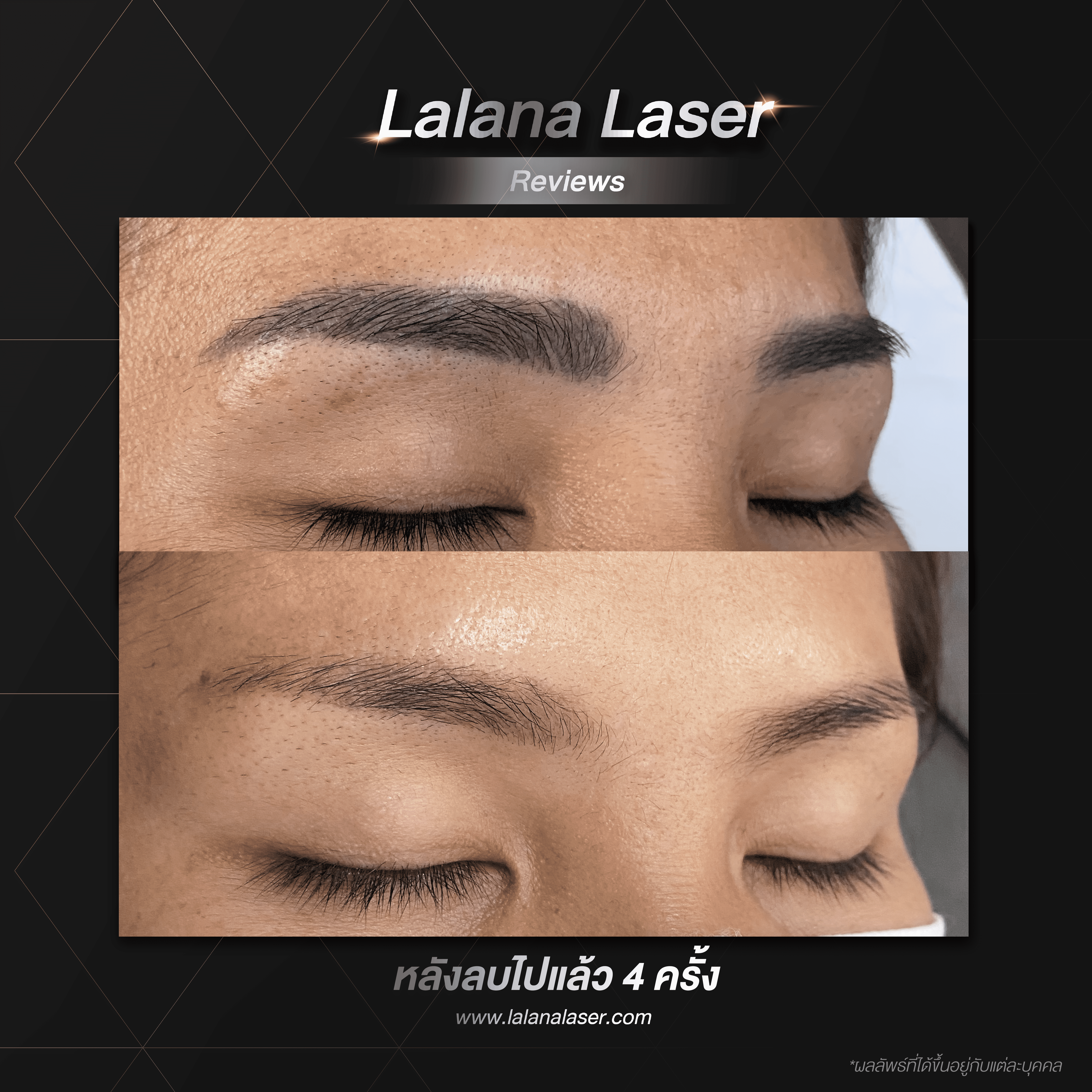 Lalana-laser-reviews-คุณแพรทอง-copy