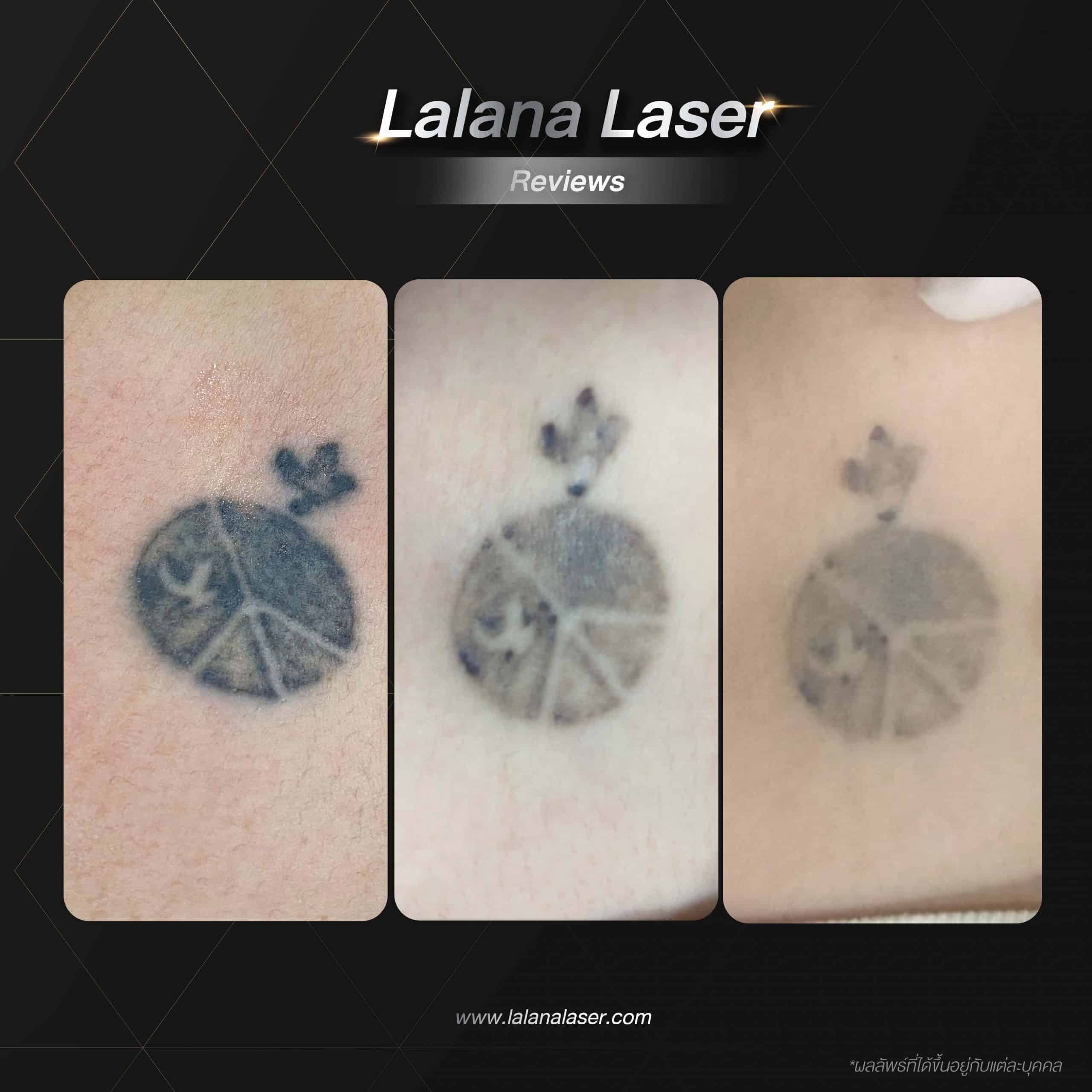 lalana-laser-reviews-free-case-2-scaled